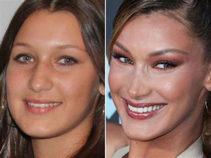 Bella Hadid Before and After Plastic Surgery Including Nose Job and
