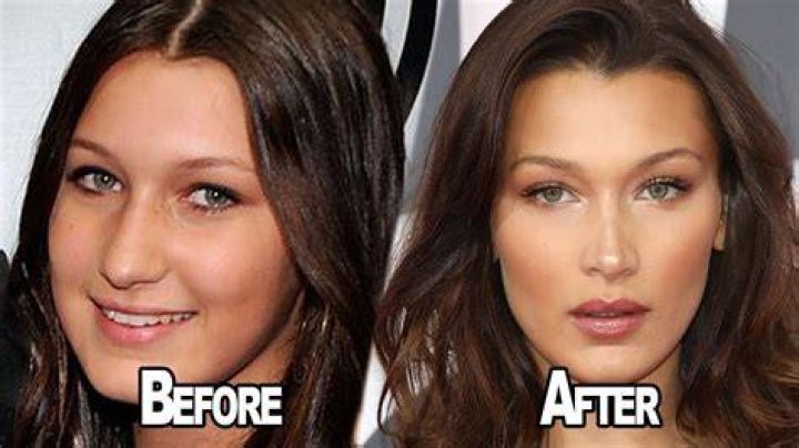 Bella Hadid plastic surgery Before and after WHO Magazine