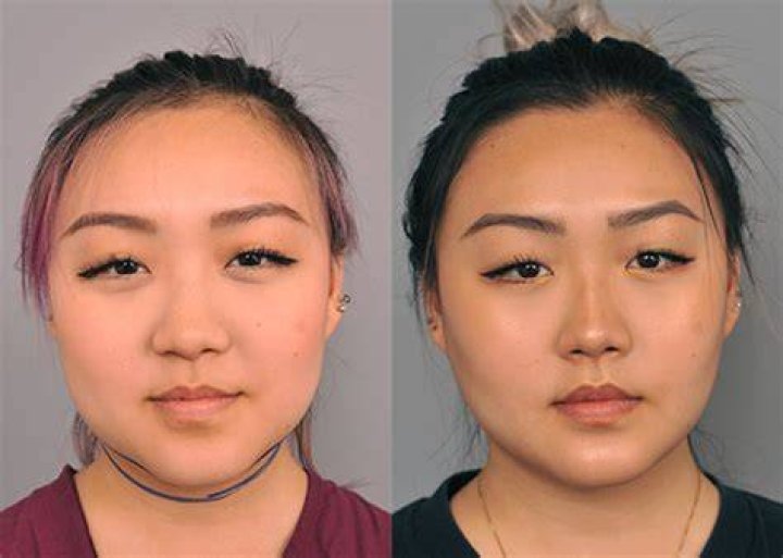 Buccal fat removal is the new celebrity trend Entertainment Talk