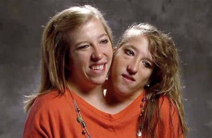 Conjoined twins Abby and Brittany Hensel break silence after surprise
