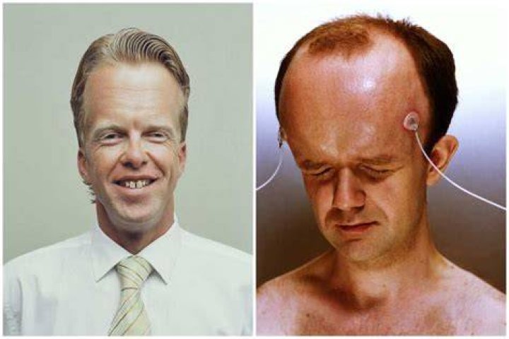 Discover The Secrets Behind The Largest Forehead In The World