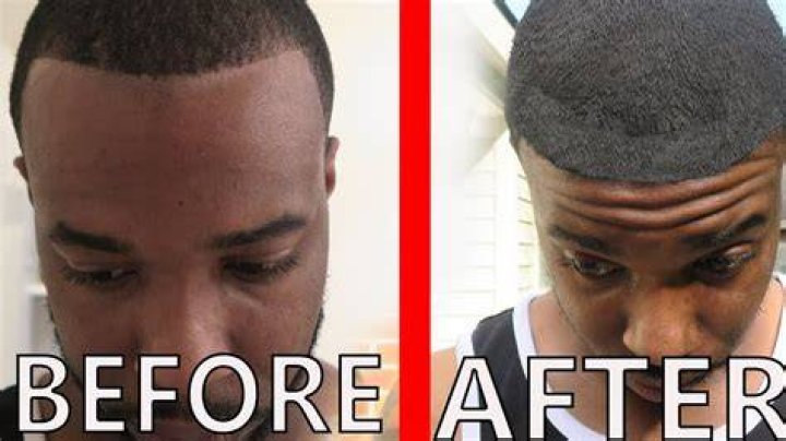 I FIXED MY HAIRLINE! YouTube