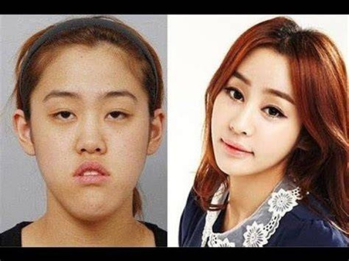 Korean Artist Plastic Surgery Before And After