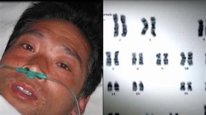 Man Survived 83 Days After Tokaimura Nuclear Accident, 45 OFF
