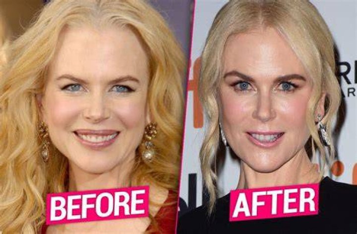 Nicole Kidman Plastic Surgery Photos [Before & After] Surgery4