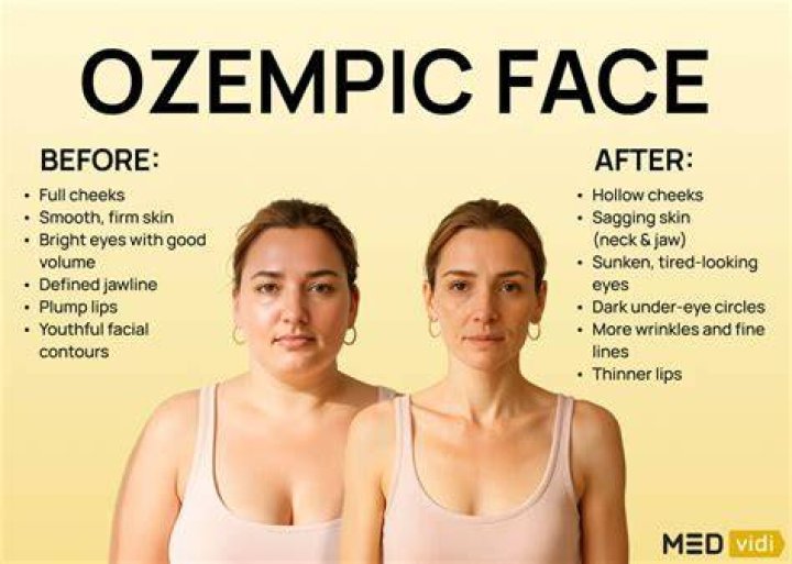 Ozempic Face The Saggy Side of Semaglutide