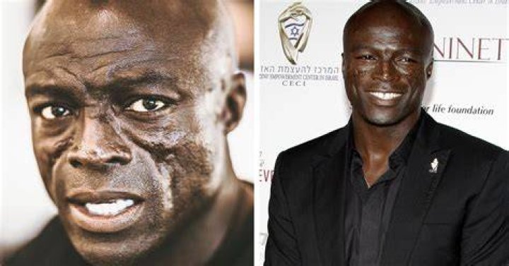 Seal says facial scars are caused by lupin, which he got when he was 21