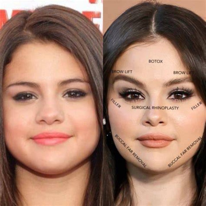 Selena Gomez & Plastic Surgery Experts Claim She Had Work Done