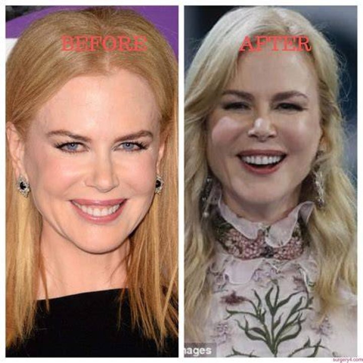 The Stunning Transformation: Nicole Kidman's Post-Surgery Journey