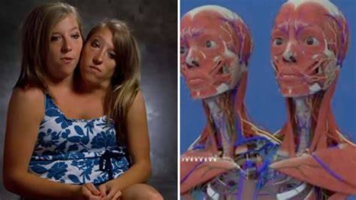 The Tragic Cause Behind The Hensel Twins' Untimely Death