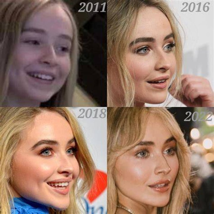 The Truth About Sabrina Carpenter's Lip Fillers