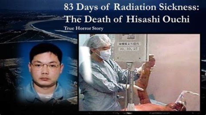 The Unbelievable Story Of The Man Who Defied Radiation: 83 Days Of Survival